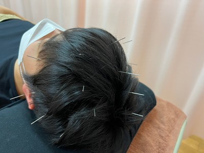 頭皮鍼 おおくぼ1のサムネイル画像