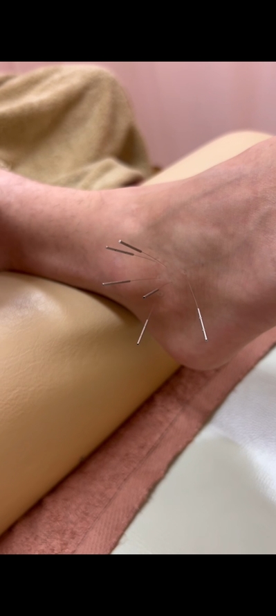 足関節 鍼のサムネイル画像